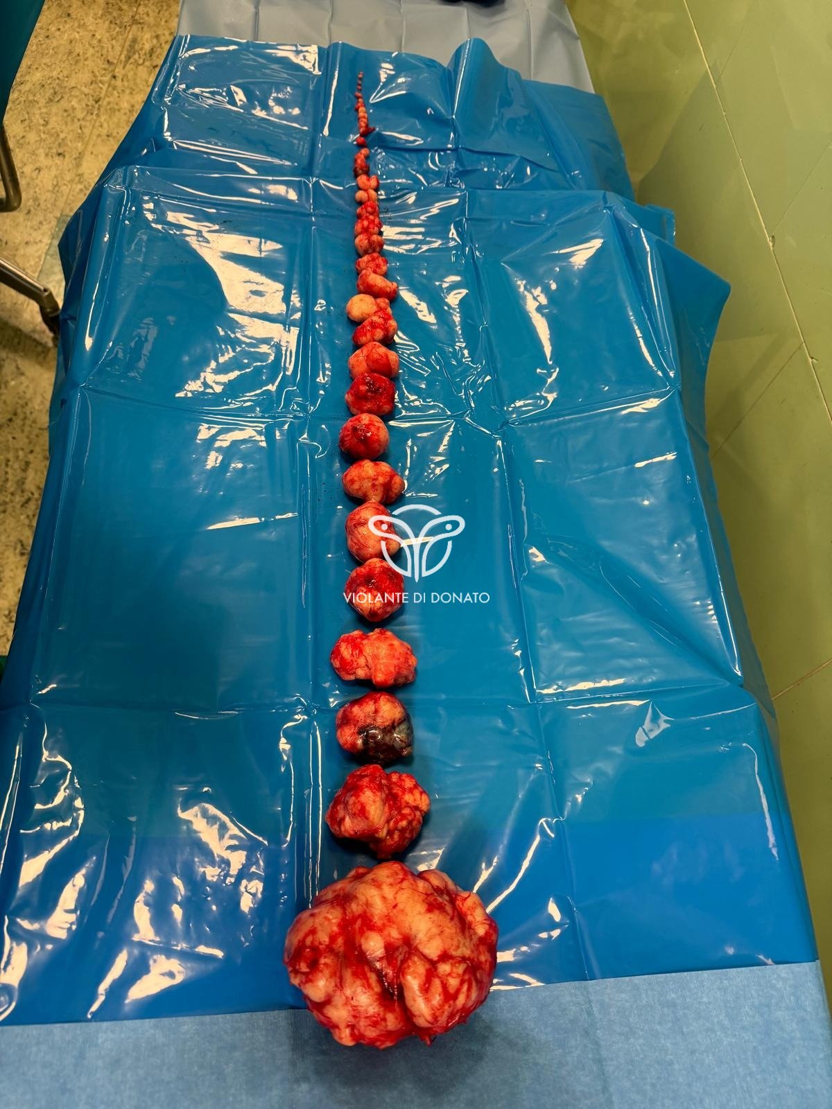 Uterine fibroids after multiple myomectomy — Prof. Violante Di Donato