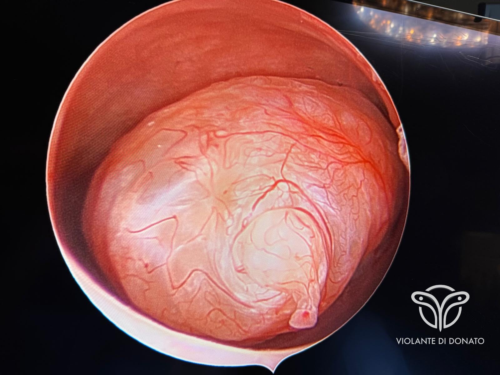 Visione isteroscopica di polipo uterino — Prof. Violante Di Donato